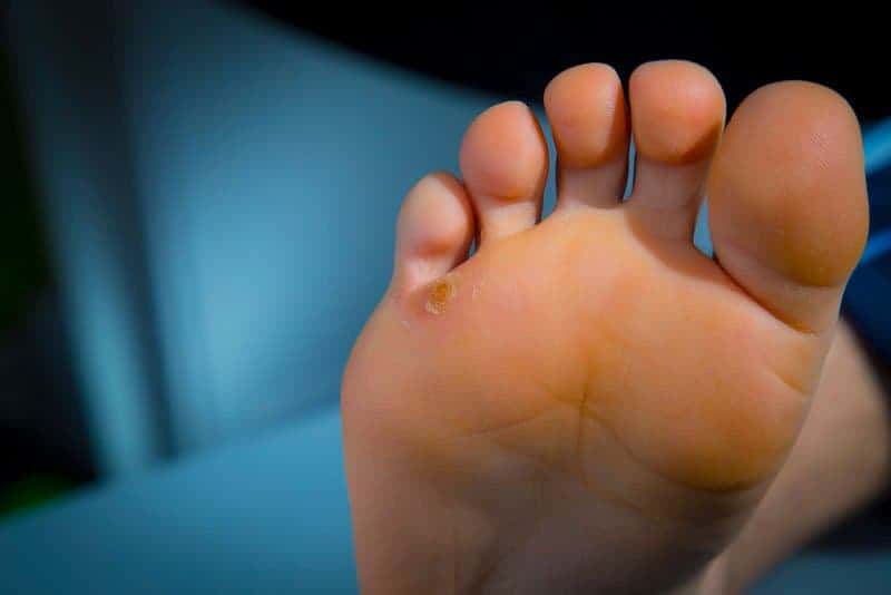 kurje oko, zulj sa jezgrom na stopalu