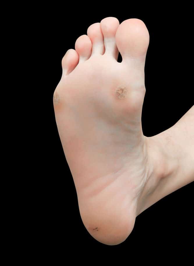 Zuljevi-Zulj bez jezgra, tvrd zulj na stopalu