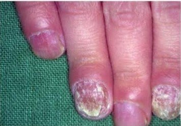 Candida gljivice na noktima