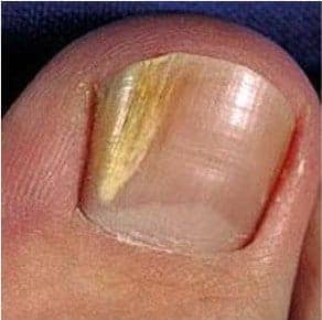 DLSO-gljivice-na-noktima