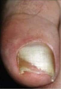 Endonyx gljivice na noktima