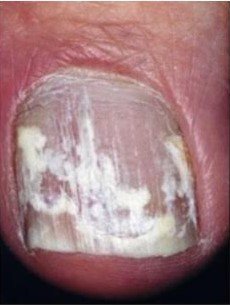 SBO - gljivice na noktima