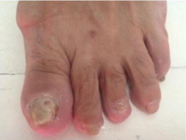 TDO gljivice na noktima